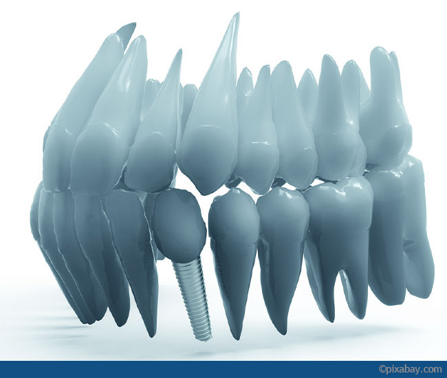 Zahnimplantate - Aufbau, Arten, Behandlung & Kosten